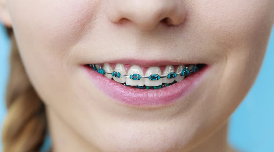 Traditional Braces